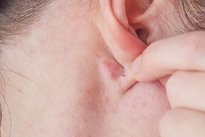Boule derrière l'oreille : 6 causes principales (et que faire)
