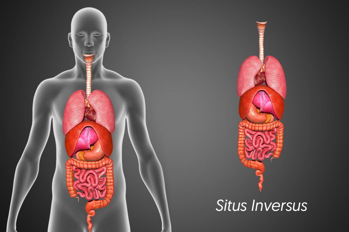 O Que é Situs Inversus Tua Saúde