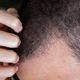 Dermatite: o que é, sintomas, tipos, causas e tratamento (com fotos)