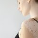 Manchas blancas en la piel: 9 causas y qué hacer
