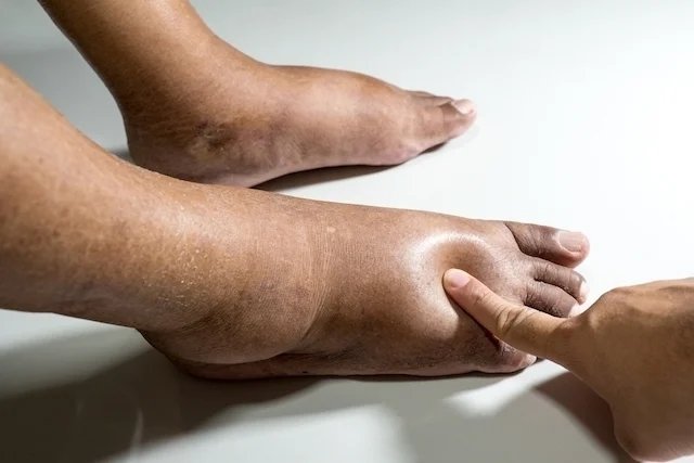 11 síntomas de mala en pies y piernas (y tratamiento)