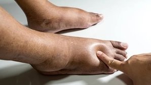 11 síntomas de mala circulación en pies y piernas (y tratamiento)
