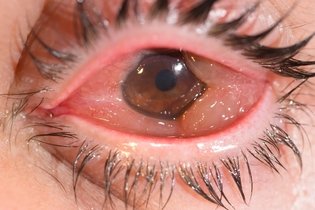 Imagem ilustrativa do artigo Quemose no olho: o que é, sintomas, causas e tratamento