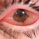 Quemose no olho: o que é, sintomas, causas e tratamento