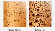 Osteopenia: síntomas, causas y tratamiento