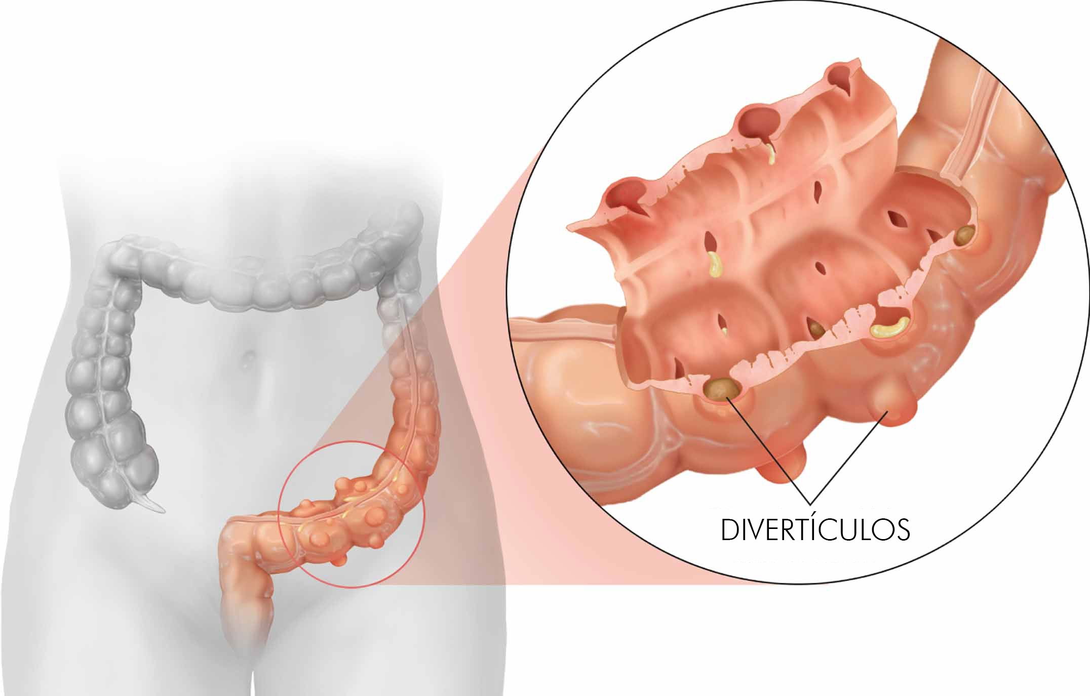 Colite Pseudomembranosa O Que Sintomas Causas E Tratamento Hot Sex Picture