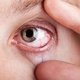 Arranhão no olho: sintomas, tratamento e quando ir ao médico