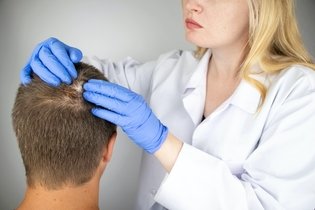 Micose no couro cabeludo: sintomas, causas e tratamento