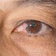 Pterígio no olho: o que é, principais sintomas e tratamento