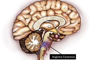 O Que E Angioma Cavernoso Sintomas E Tratamento Tua Saude