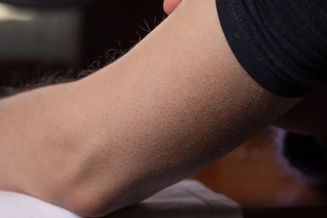 Ronchas granos en el brazo: 6 causas y