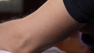 Ronchas o granos en el brazo: 6 causas y qué hacer