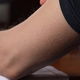 Ronchas o granos en el brazo: 6 causas y qué hacer