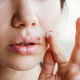 Herpes tem cura?