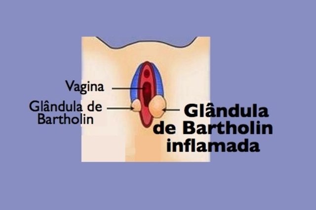 Como tratar a inflamação da glândula de Bartholin