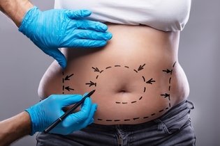 Imagen ilustrativa del artículo Liposucción: Cómo es el postoperatorio y qué cuidados tener