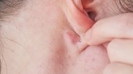 Bulto o bolita detrás de la oreja: 6 causas y qué hacer