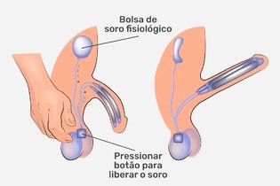 Imagem ilustrativa do artigo Prótese peniana: o que é, quando é indicada, tipos e cirurgia