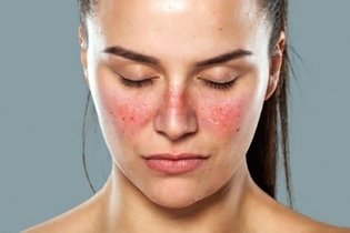 Vermelhidão no rosto: 16 principais causas e o que fazer