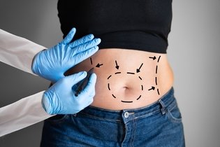 Imagem ilustrativa do artigo Principais riscos da abdominoplastia e como evitar
