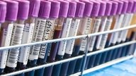 ESR Blood Test: Normal Ranges & What It Means