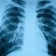 Como é o contágio da pneumonia e como prevenir