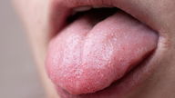 Bumps on Tongue: 6 Common Causes & What to Do