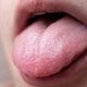 Bolinhas na língua: o que pode ser (e o que fazer)