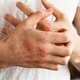 Eczema numular: o que é, causas, sintomas e tratamento