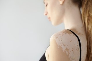 9 causas de manchas brancas na pele (e o que fazer)