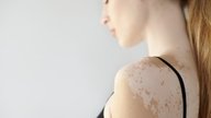9 causas de manchas brancas na pele e o que fazer