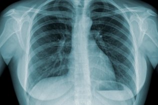 6 síntomas de tuberculosis (pulmonar y extrapulmonar)