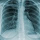 7 principales síntomas de tuberculosis (pulmonar y extrapulmonar)