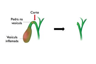 ducto biliar com e sem vesícula