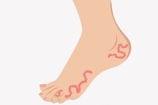 Coceira nos pés: 10 principais causas e o que fazer