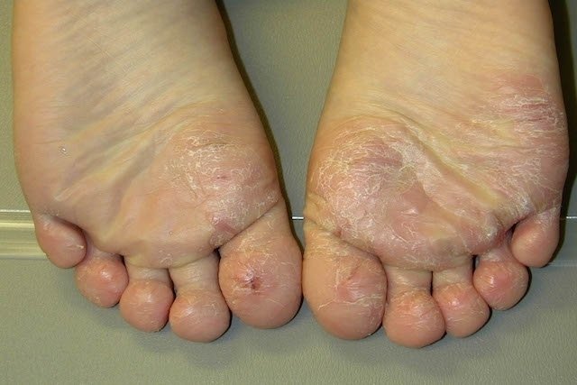 6 Home Remedies For Athlete's Foot In Children