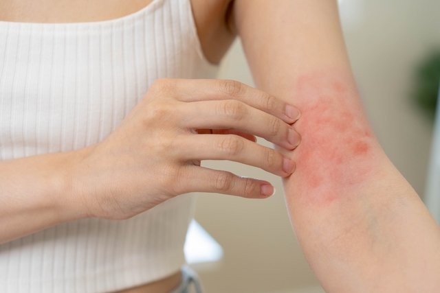 Alergia en el brazo
