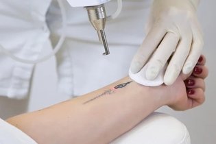 Imagen ilustrativa del artículo Cómo quitar un tatuaje (definitivo y de henna negra)