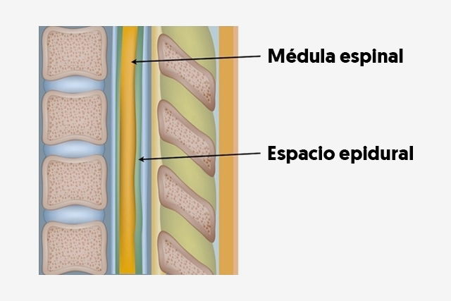 Anestesia Epidural Qué Es Efectos Secundarios Y Aplicación Tua Saúde