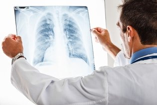 Imagen ilustrativa del artículo Bronconeumonía: síntomas, causas y tratamiento