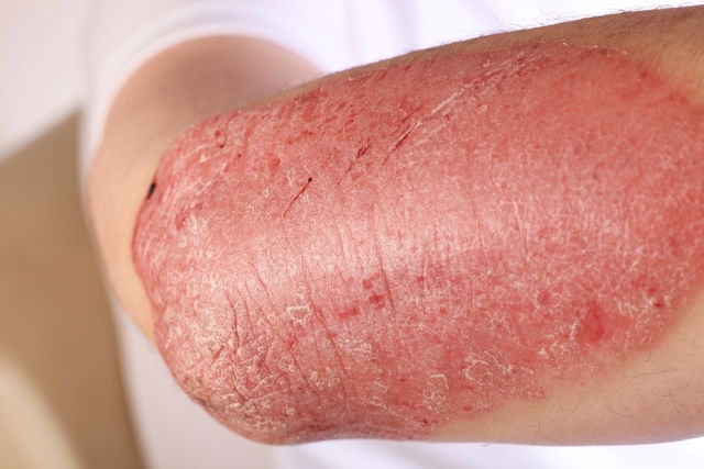 Genital Psoriasis: Symptoms, Treatment & Tips for Recovery - Tua Saúde