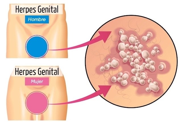 Wounds caused by genital herpes 