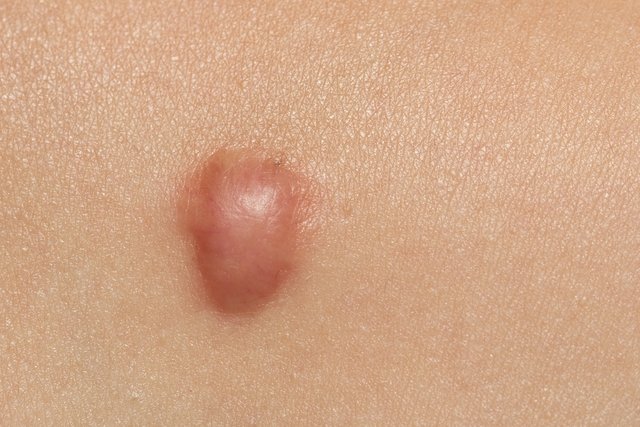 5 أنواع من سرطان الجلد: كيفية التعرف عليها وماذا تفعل
