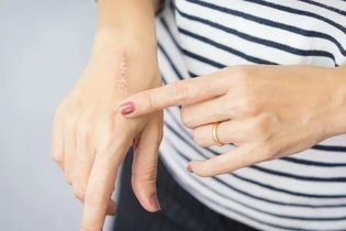 Imagem ilustrativa do artigo Como tratar a cicatriz de queimadura (de 1º, 2º e 3º graus)