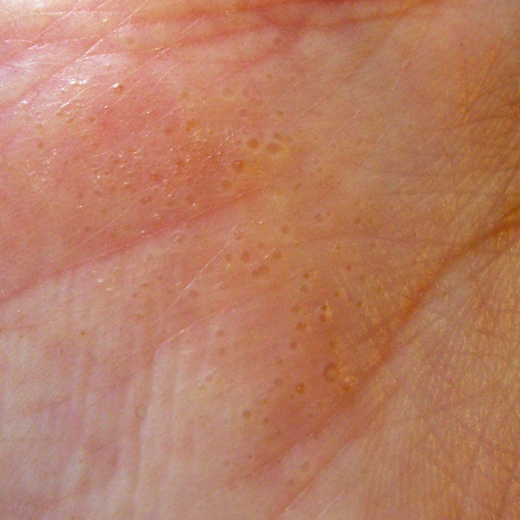 dyshidrosis-hands-and-pies-what-is-it-causes-and-treatment