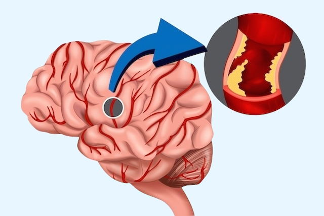 Como Tratar O Avc E Evitar As Sequelas Tua Sa De