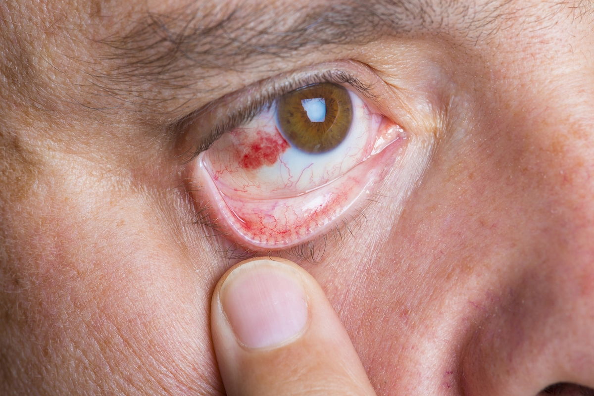 Derrame Ocular Qué Es Causas Síntomas Y Cómo Tratar Tua Saúde 4952