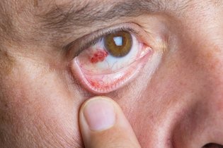 Derrame en el ojo: causas, síntomas y cómo tratar