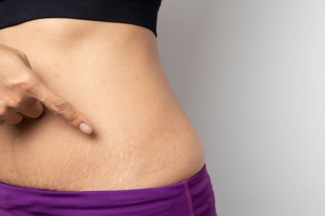 Illustrative image of the article How to Get Rid of Stretch Marks: 11 Treatments to Try