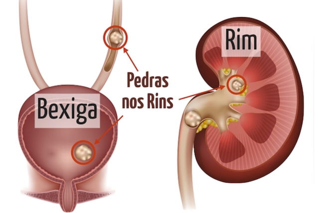 Quais os Sintomas e como é feito o Tratamento para Pedra nos Rins - Tua  Saúde